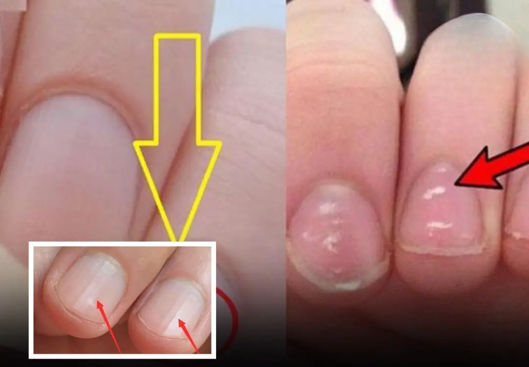 Your Nails Might Be Warning You: 3 Health Signs You Shouldn’t Ignore