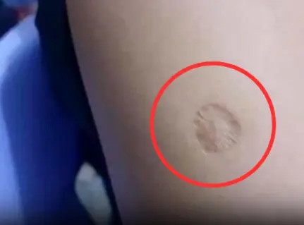The Story Behind the Small Round Scar on Your Arm