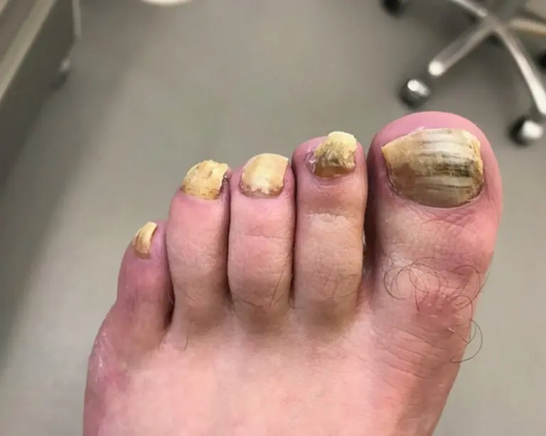 My toenails are thick, yellow, and getting worse, and I can’t see a doctor anytime soon. What can I do for now?