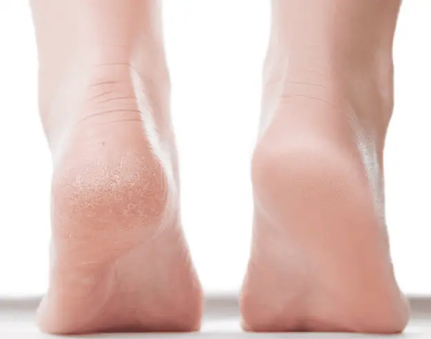 Not all cracked heels come from dry skin: here are other possible causes