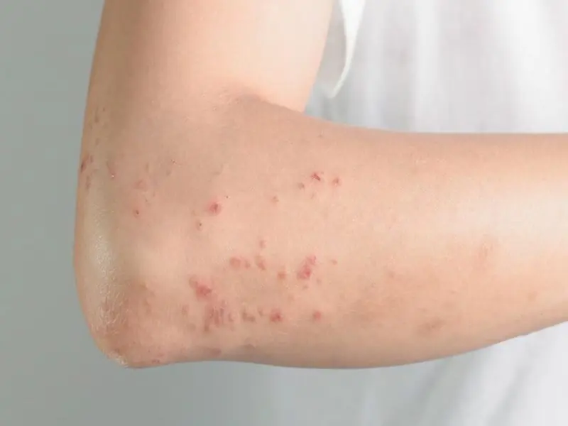 What really causes hives? Surprising triggers that may affect your skin