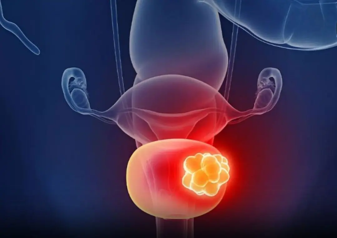 Bladder Cancer Often Starts Quietly: 5 Early Symptoms to Watch For