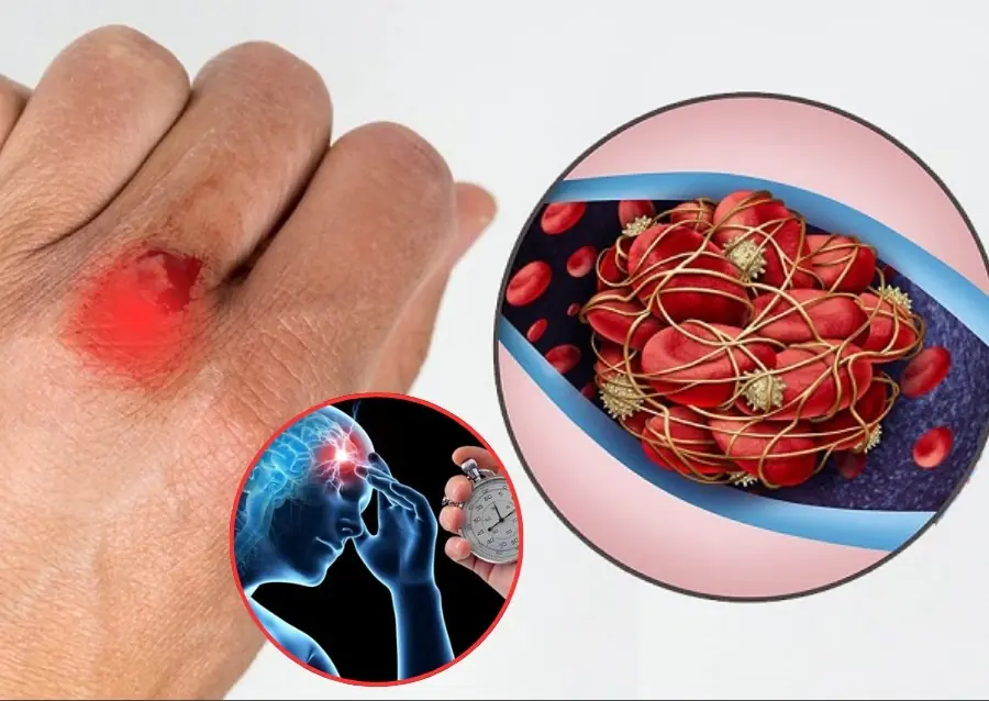 these 9 silent brain clot signs can appear weeks earlier