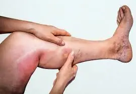 6 Herbal Infusions That Help Keep Arteries Healthy