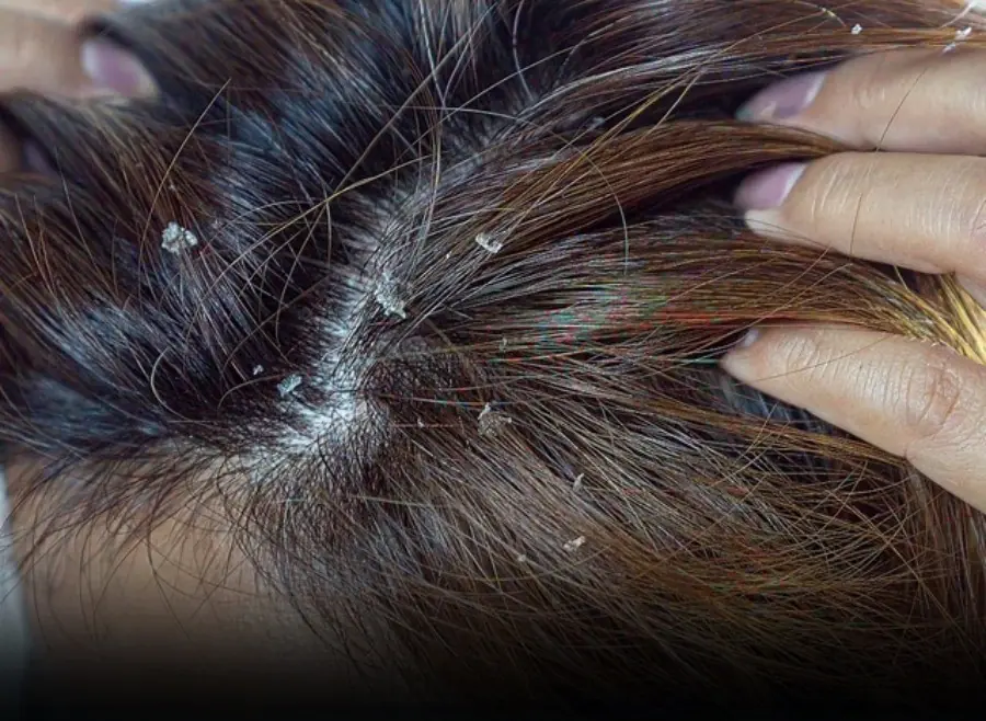What looks like dandruff may be something far more serious — ignoring this sign could cost you precious time