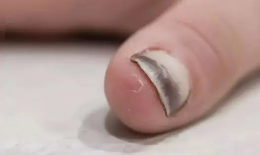 When Cancer Develops, These Three Signs May Appear in the Limbs