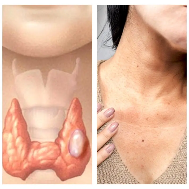 Avoid These 6 Foods That May Negatively Affect Your Thyroid
