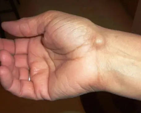 A Small Lump That Could Be Caused by Your Everyday Routine