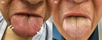 Scalloped tongue: A useful indicator in diagnosing tongue swelling