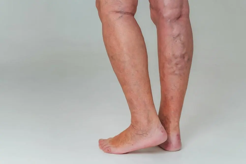 Why Do Feet, Ankles, and Legs Become Swollen? Possible Causes Explained
