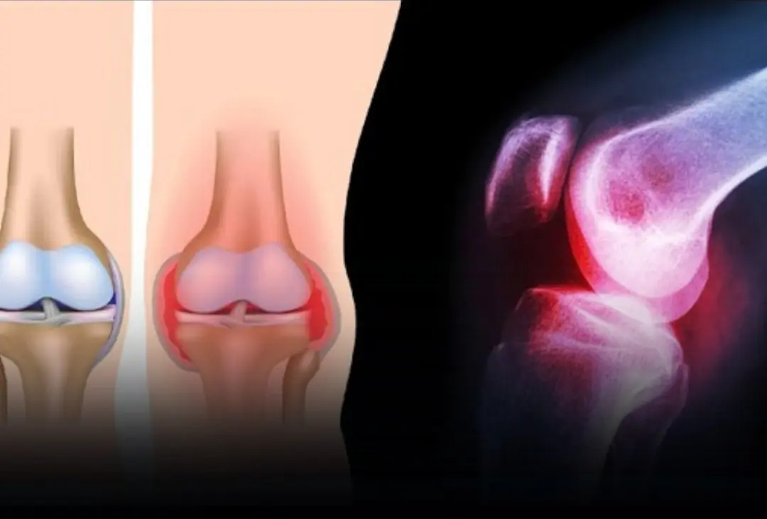 6 Common Foods That Can Interfere With Calcium Levels and Affect Bone Health