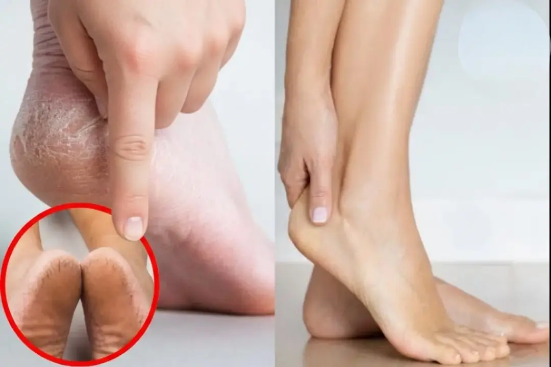 Cracked heels are not always caused by dry skin: Be aware of these conditions