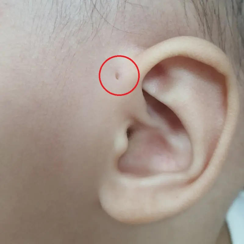 Do You Know Someone With This Small Mark on Their Ear? Here’s What It Might Mean