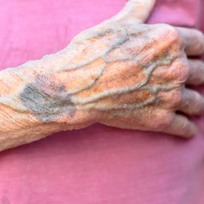 Warn Them As Soon As Possible: What Bulging Veins Might Be Telling You