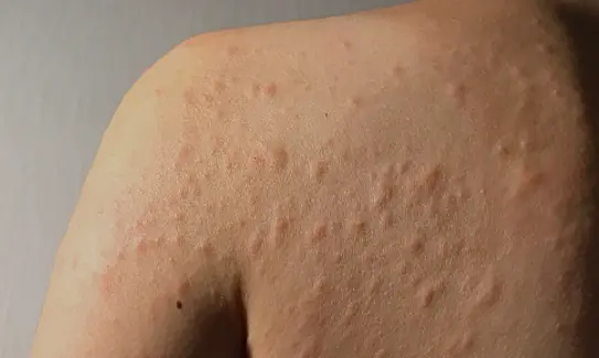 He Thought It Was Just an Allergy — But the Cause of His Severe Itching Was Something Else