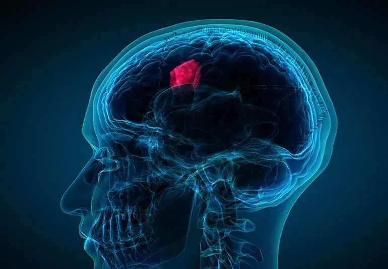 Key Warning Signs of a Brain Tumor That Should Not Be Ignored