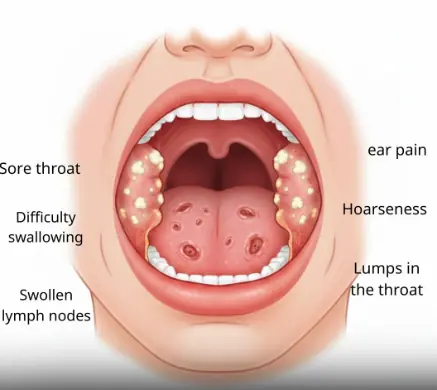 What Symptoms Does HPV Cause in the Throat?