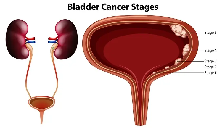 7 Early Warning Signs of Bladder Cancer You Should Know