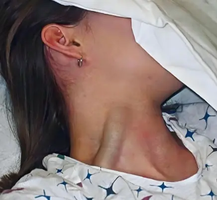 Massive jugular vein distension: a warning sign you shouldn’t ignore