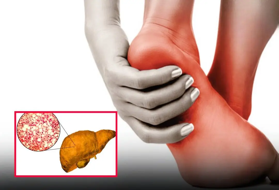 A change in your feet may signal severe fatty liver disease — don’t ignore it