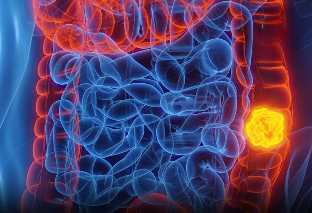 Woman with Stage - Four Colon Can:cer Reveals 5 Symptoms She Overlooked