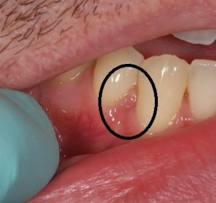 These may be the initial symptoms your gums are trying to show