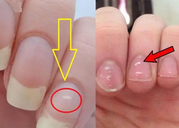 Look at Your Nails Carefully — These 3 Changes Could Mean You Should See a Doctor.