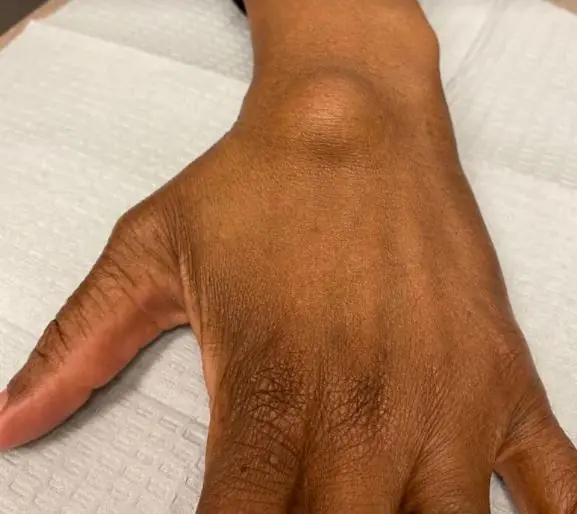 Understanding Ganglion Cysts: Causes, Symptoms, and Treatment Options