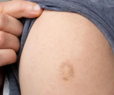 The Meaning Behind the Common Scar on the Upper Left Arm