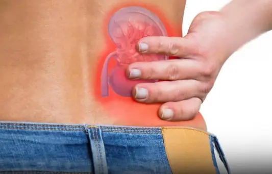 4 Everyday Drinks That May Help Prevent Kidney Stones