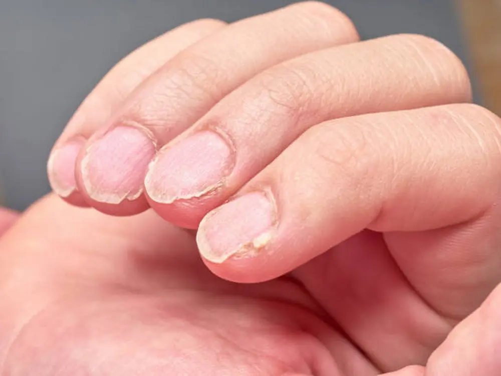 What Frequent Nail Splitting Could Be Telling You About Your Body?