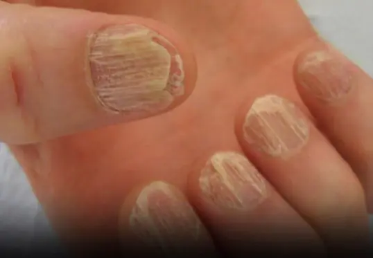 9 Changes in Your Nails That Could Indicate Health Problems