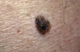 The culprit behind hairy moles could treat pattern baldness