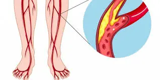 Doctors Recommend These 5 Habits for People With High Blood Pressure, Stroke Risk, or Varicose Veins