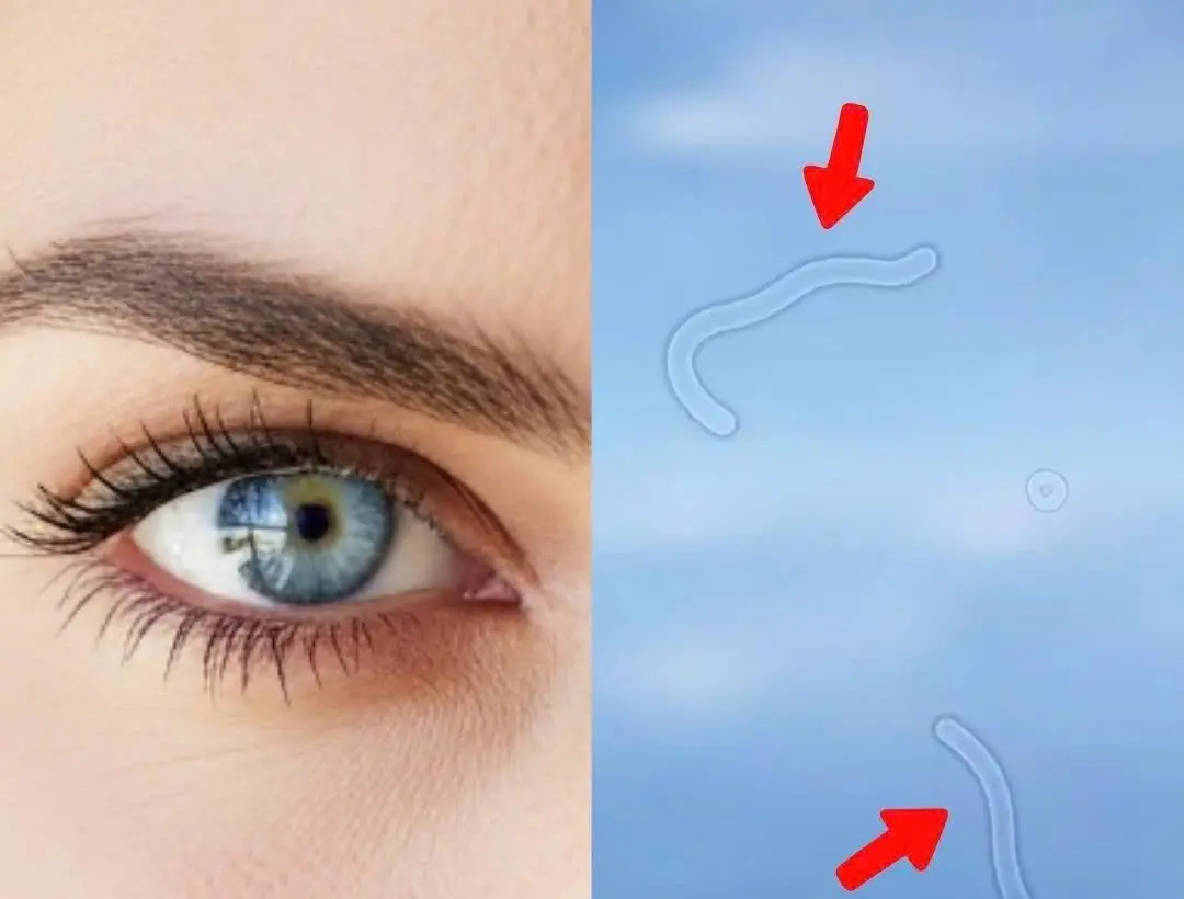 Eye Doctor Explains What to Do If You Start Seeing “Floaters”
