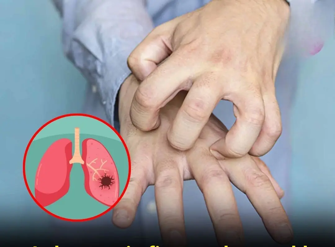4 finger changes that may signal lu:ng can.cer — see a doctor right away!
