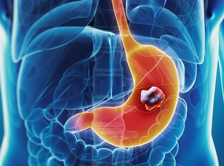 10 Possible Symptoms of Late-Stage Stomach Can.cer to Be Aware Of