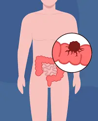 5 Clear Warning Signs of Colon Cancer You Should Never Ignore