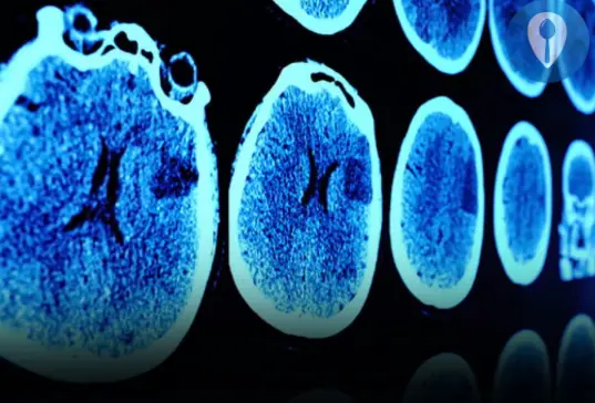 7 Possible Brain Cancer Symptoms Every Woman Should Be Aware Of