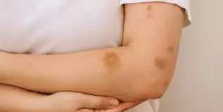 If You’re Getting Bruises Without Injury, Here’s What Your Body Might Be Telling You