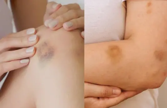 If You Notice These Bruises, Pay Attention to What They Could Mean
