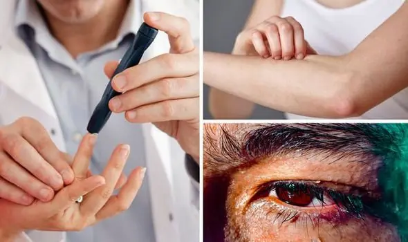 Signs of High Blo.od Sugar: These People Are Most at Risk of Developing Diabetes