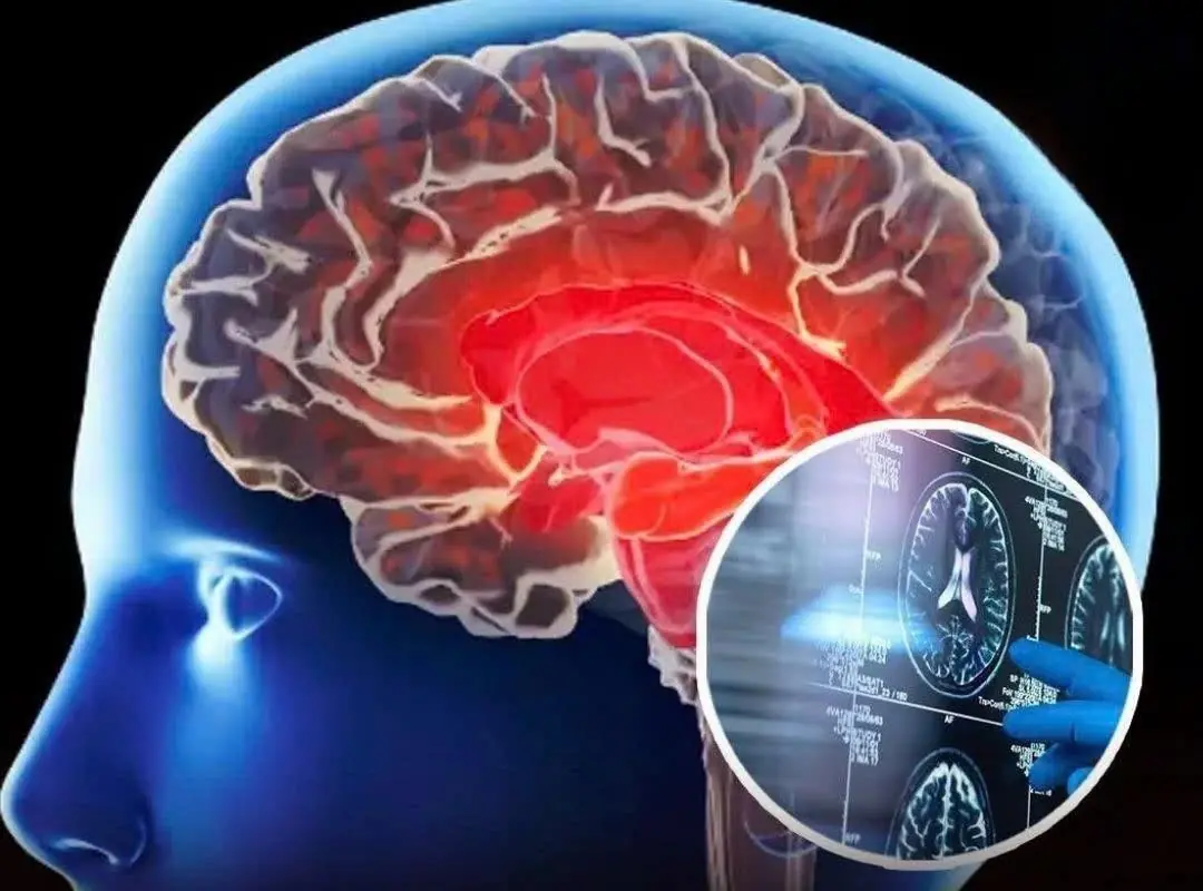 4 Red Flags Your Brain May Be in Trouble — Scientists Say Alzheimer’s Can Begin Decades Earlier