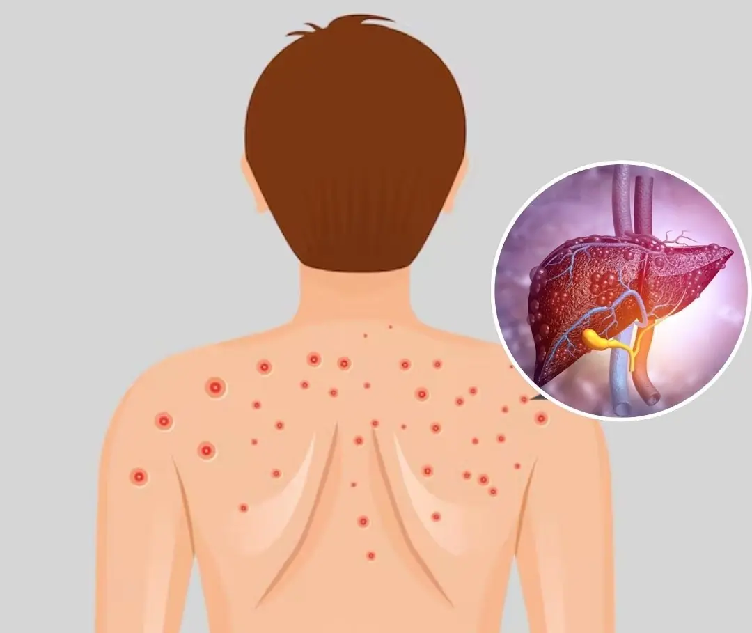 A Common Sign That May Be Linked to Fatty Liver Disease