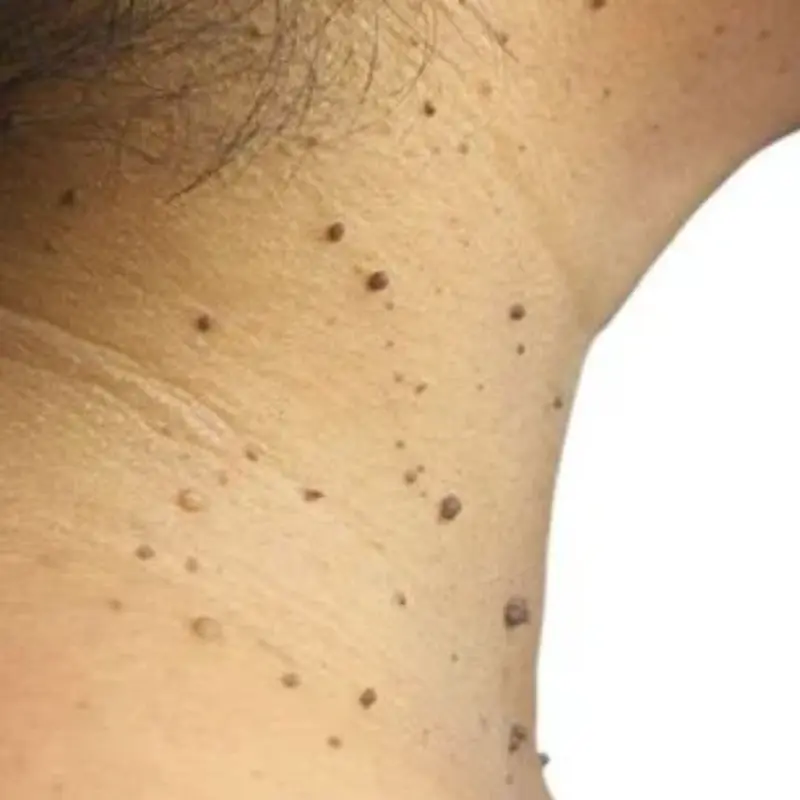 What Those Small Skin Bumps on Your Neck Might Actually Mean