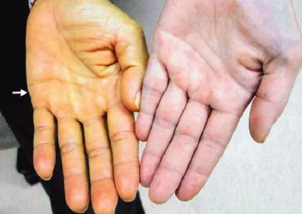 3 Unusual Signs on Your Hands That Could Warn of Can.cer — Many People Ignore Them