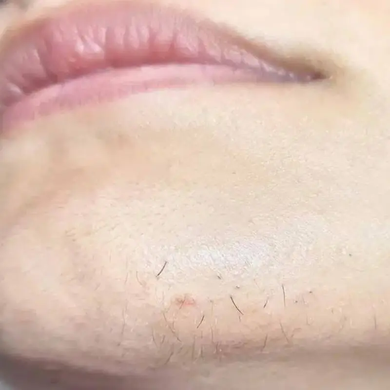 What Chin Hair in Women Can Reveal About Health and Hormones