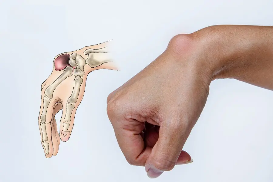 Bone Cancer: 5 Warning Signs Doctors Say You Should Know