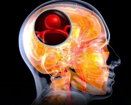 2 Symptoms That May Signal a Brain Aneurysm
