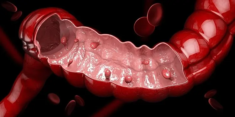 Finding colon polyps early can significantly reduce the risk of colorectal can.cer